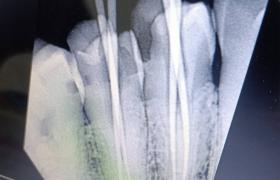 Happy endo🦷