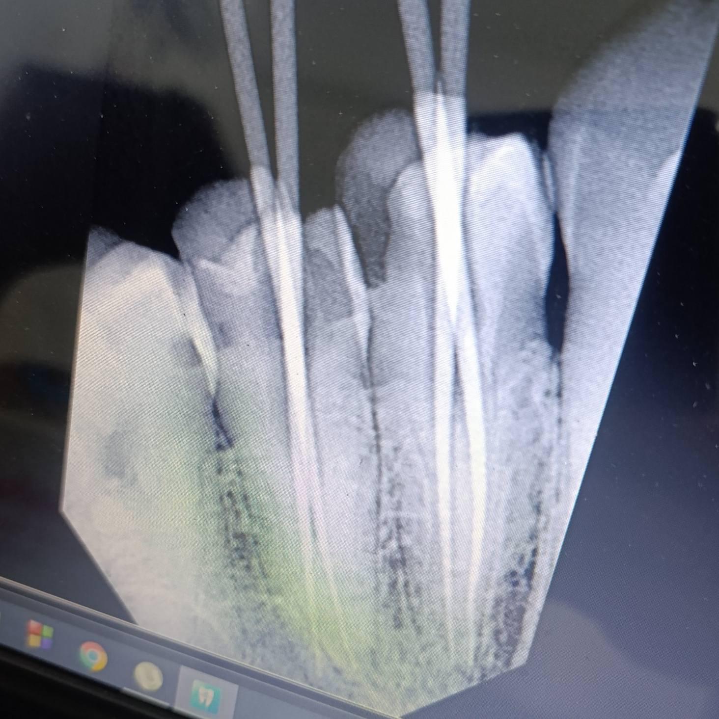 Happy endo🦷
