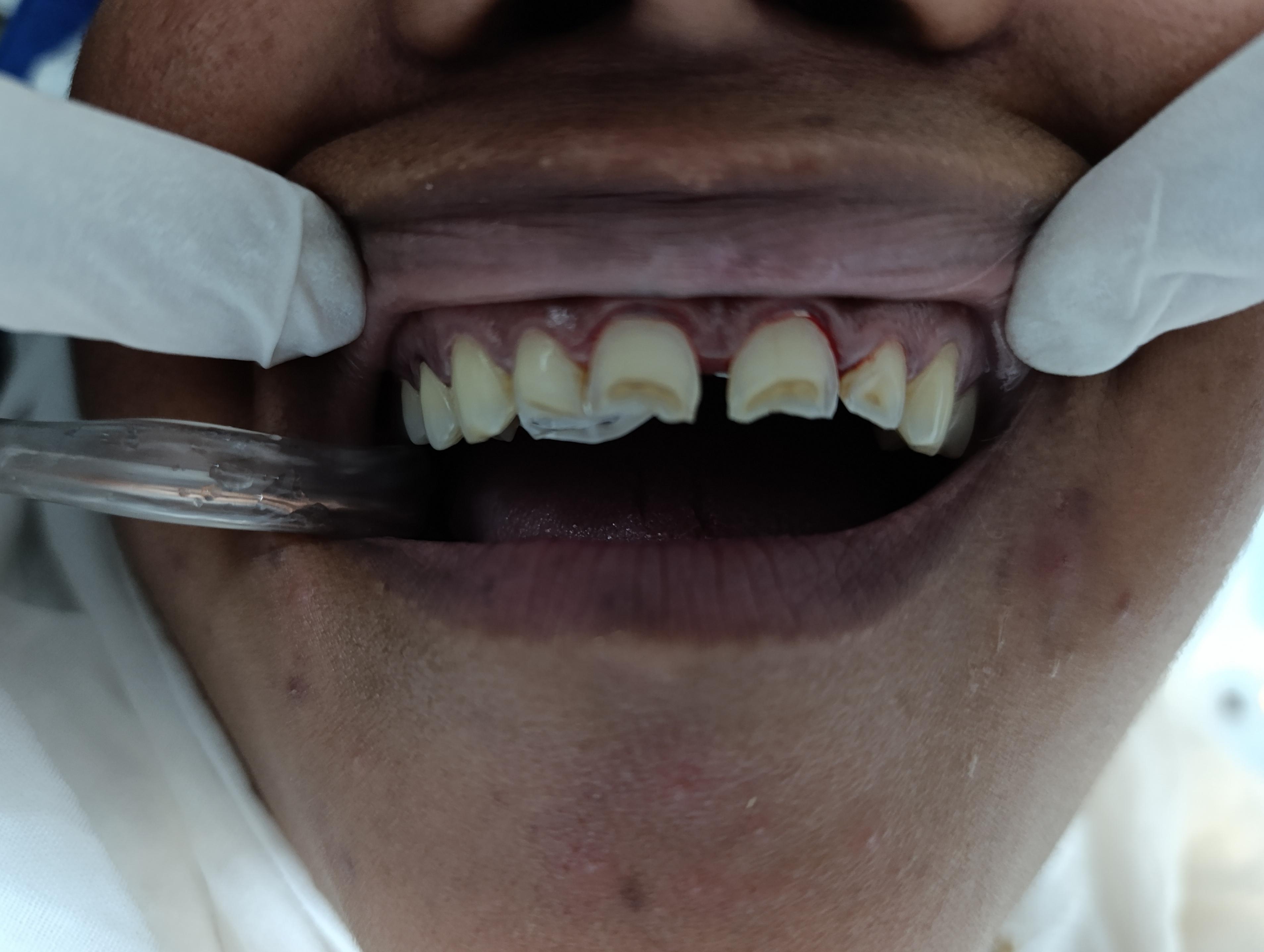 Diastema closure