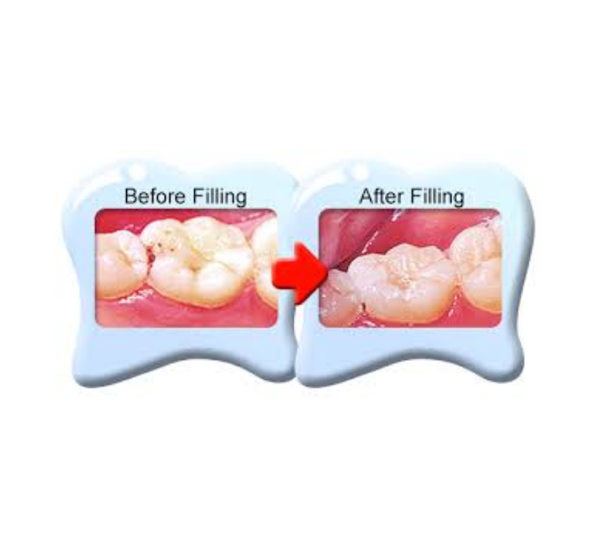 Deciduous Filling (ডিসিডিউস ফিলিং)